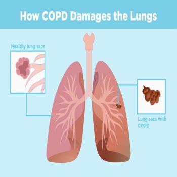 COPD